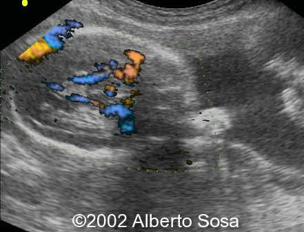 case0091-11