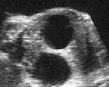 Gastric duplication cyst in association with pyloric atresia image