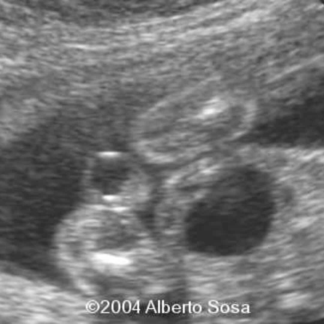 📃 Megalourethra with horseshoe kidney