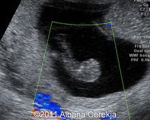 Endometrial polyps in pregnancy image