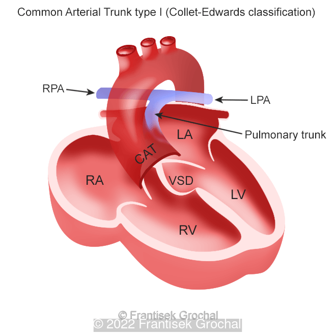 Drawing – Common Arterial Trunk type I - RPA - Right Pulmonary Artery, LPA - Left Pulmonary Artery, RA - Right Atrium, RV - Right Ventricle, LV - Left Ventricle, LA- Left Atrium, VSD - Ventricular Septal Defect.