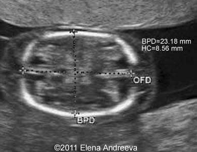 рџ ѓ Conjoined Twins