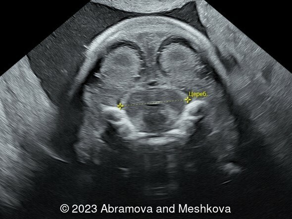 Transverse section of the brain at 20-21 weeks of gestation. Cerebellum 2.12cm, Estimated gestational age 20 weeks, 1 day (51.5%)