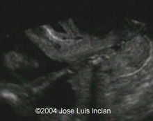 Cervical incompetence with fetal hand in the cervix image
