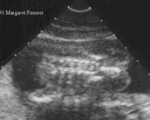 Chondrodysplasia punctata, mild symmetric type with echogenic coccyx in a 15 week fetus image