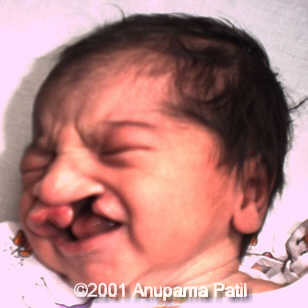 cleft lip and palate 1