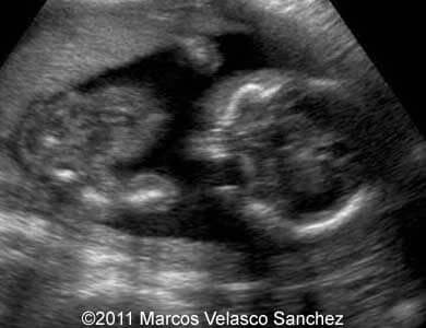 Cleft_VelascoSanchez_1