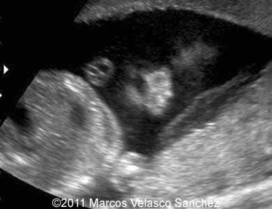 Cleft_VelascoSanchez_3