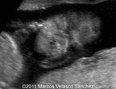 Cleft_VelascoSanchez_5