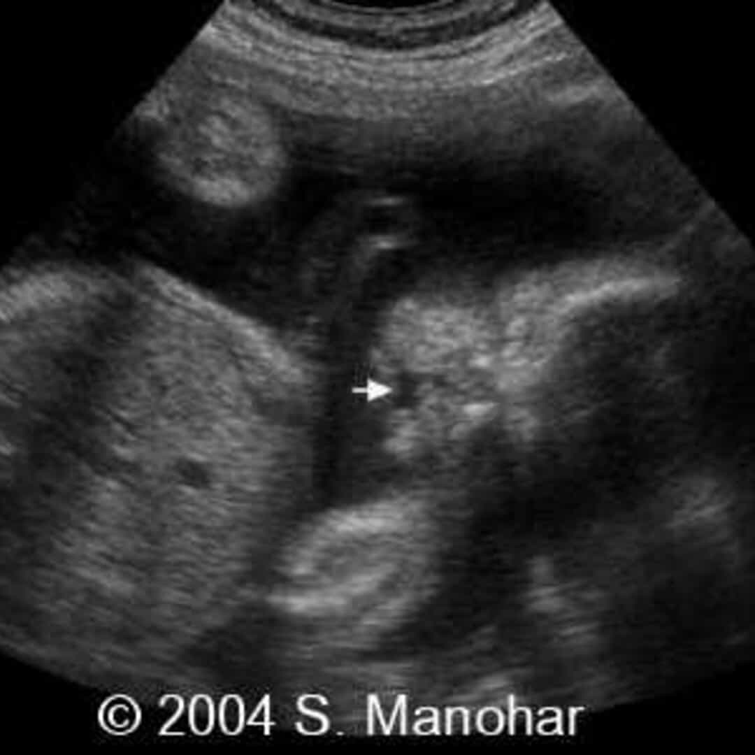 📃 Cleft lip with cleft palate