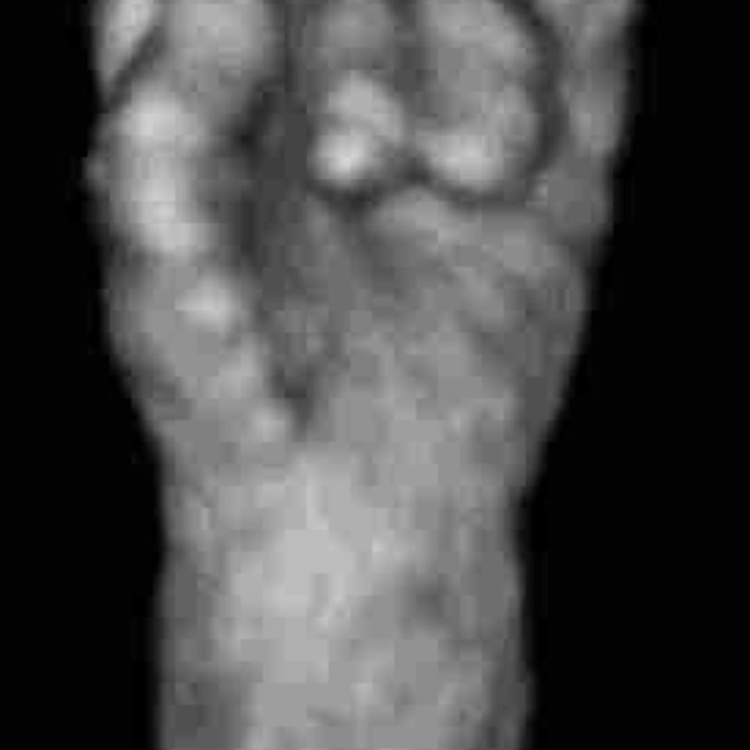 📃 Trisomy 18, clenched fist