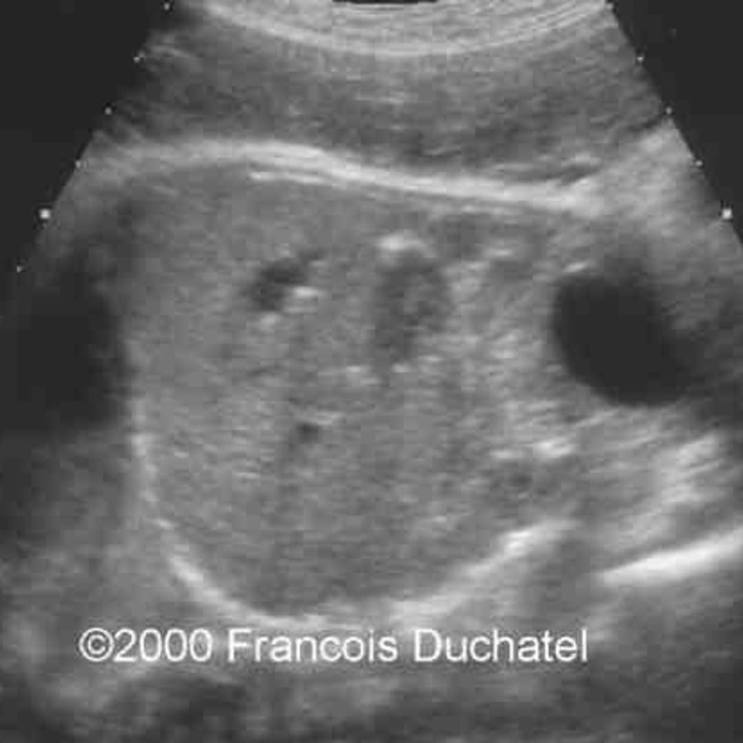 📃 Hepatic capsule calcification, idiopathic