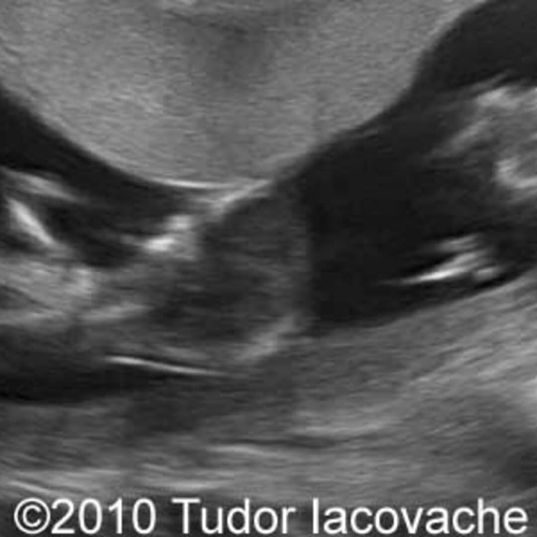 📃 Cord entanglement in the first trimester