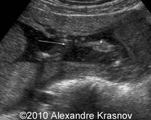 Umbilical cord adherent to the fetal hand image