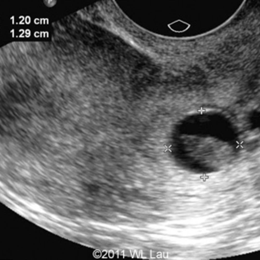 cervical ectopic pregnancy