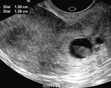 3D-ultrasound diagnosis of the cervical pregnancy image