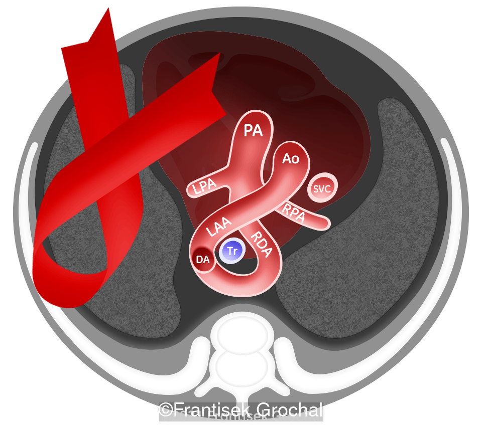 Drawing of the "cross ribbon sign" type of vascular ring. Right ductus arteriosus (RDA), left aortic arch (LAA). LPA - left pulmonary artery, RPA - right pulmonary artery, DA - descending aorta.