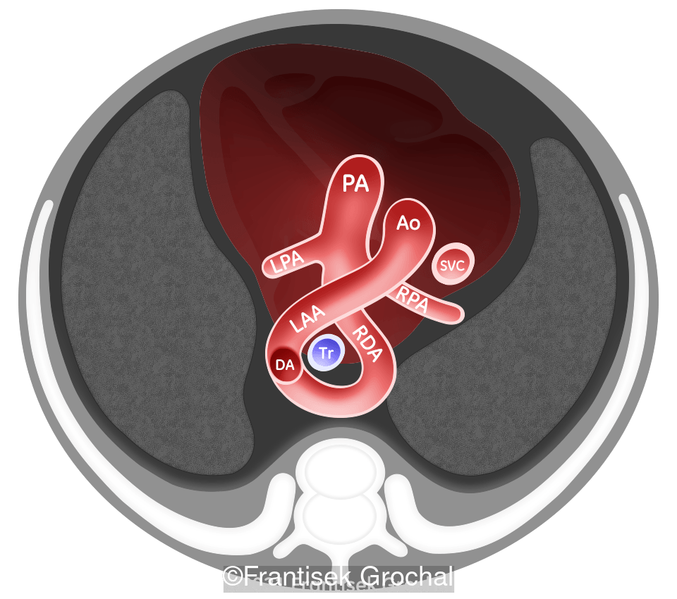 Drawing of the "cross ribbon sign" type of vascular ring. Right ductus arteriosus (RDA), left aortic arch (LAA). LPA - left pulmonary artery, RPA - right pulmonary artery, DA - descending aorta.