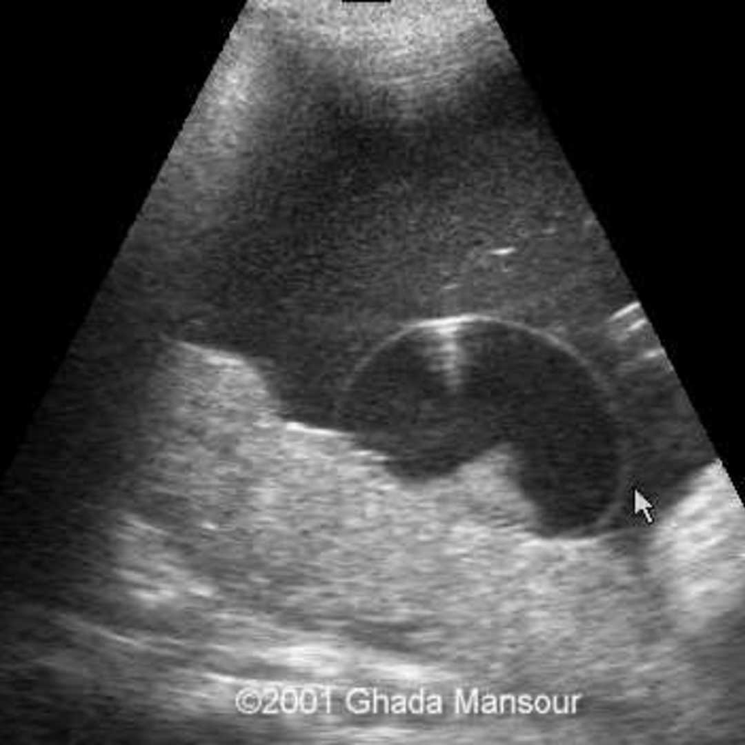 📃 Placental cysts