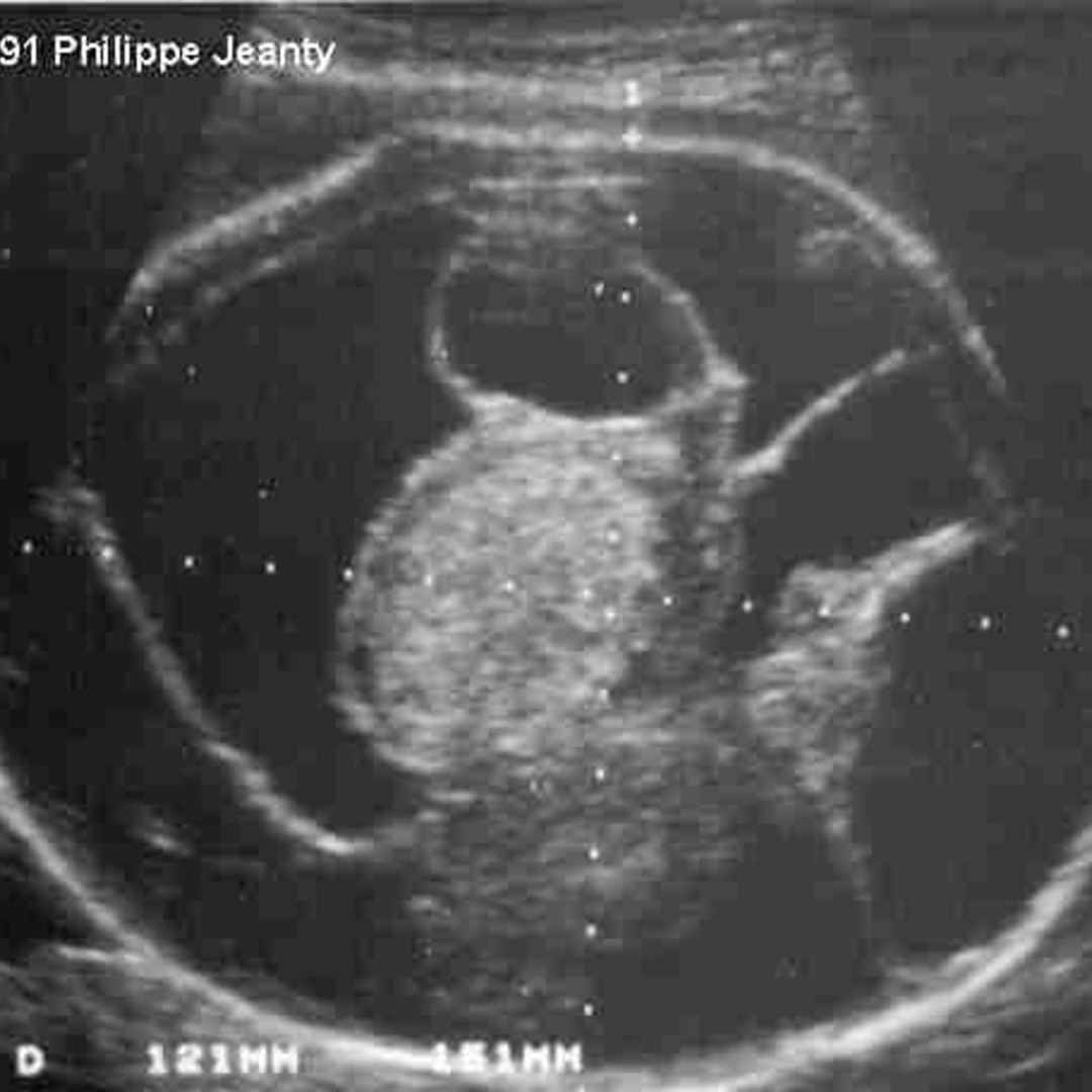 Cystic Teratoma Ultrasound Cystic Teratoma Ultrasound