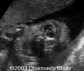 Dacryo Cystocele JPEG.4