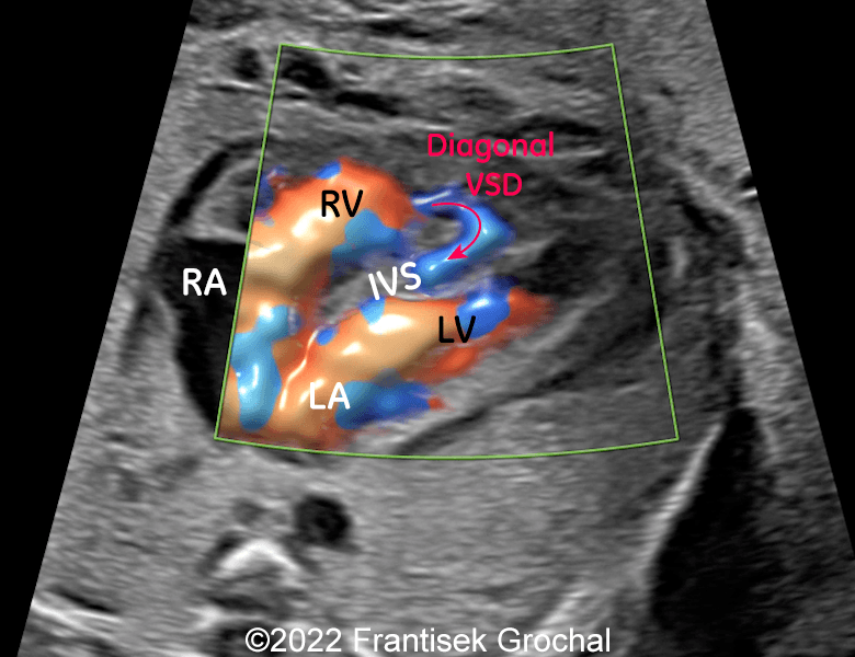 4-chamber-view showing diagonal defect within the interventricular septum which makes kind of “dissection” of its walls. LA - left atrium, LV - left ventricle, RA - right atrium, RV - right ventricle, IVS – interventricular septum.