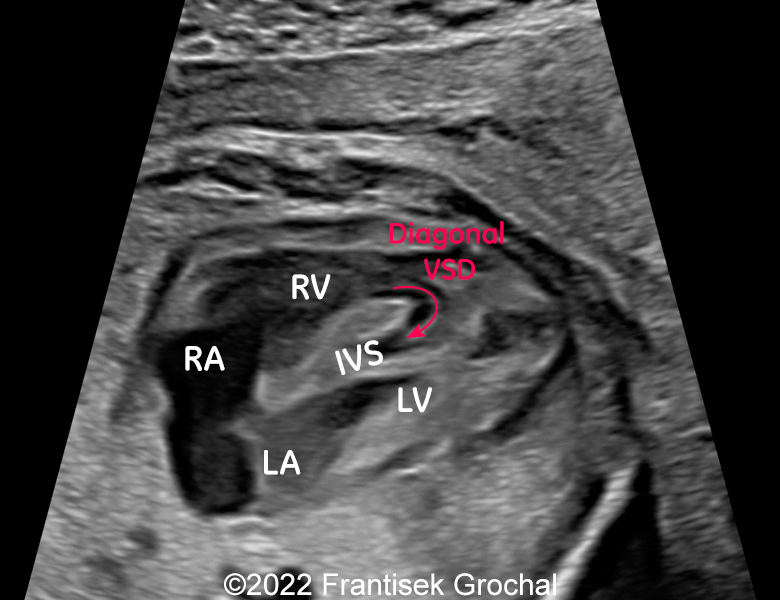 4-chamber-view showing diagonal defect within the interventricular septum which makes kind of “dissection” of its walls. LA - left atrium, LV - left ventricle, RA - right atrium, RV - right ventricle, IVS – interventricular septum.