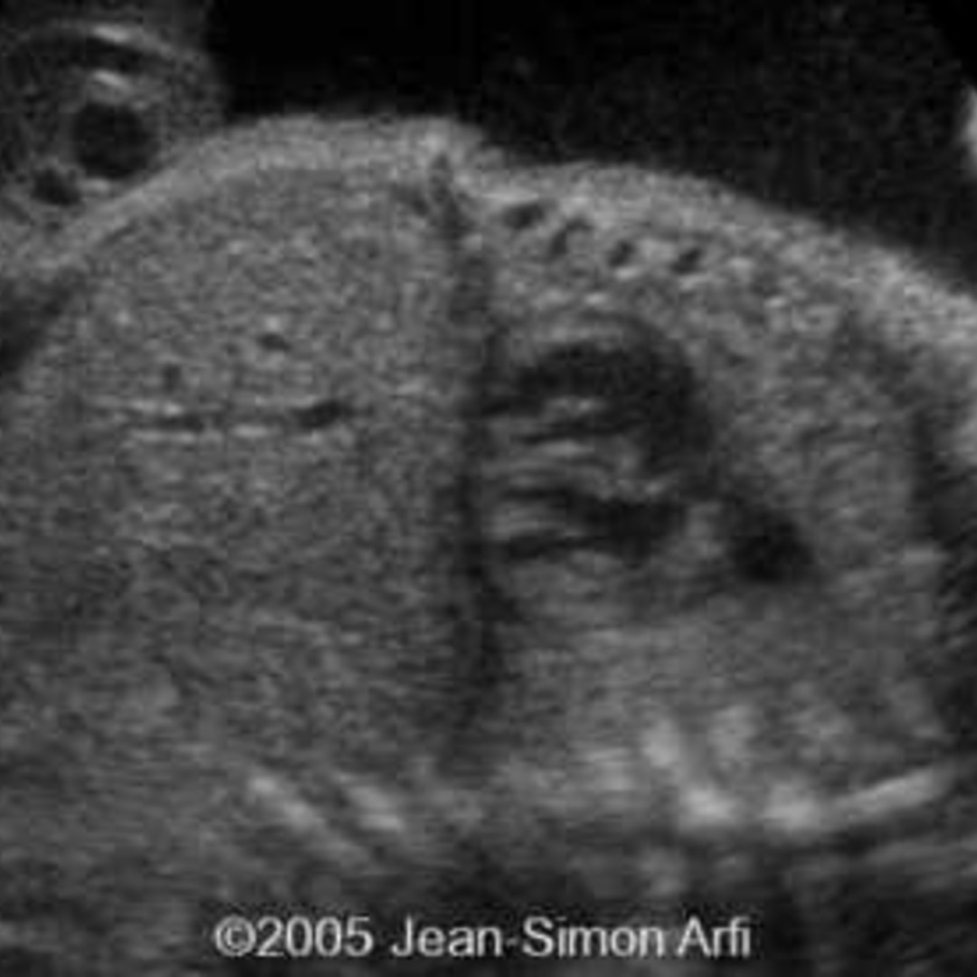 📃 Diaphragmatic hernia, right