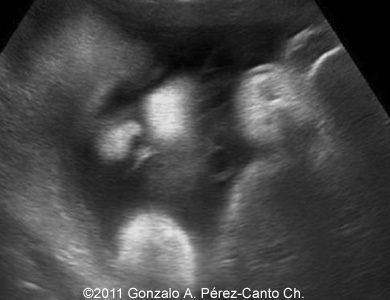 diastrophic dysplasia ultrasound