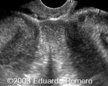 Didelphus uterus, 6 week pregnancy image