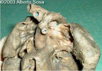 Dilatacion pulmonar