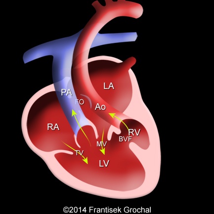 DILV-TGA-reversed-ventricular-arrangement