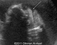 Duplicata incompleta with caudal regression syndrome image