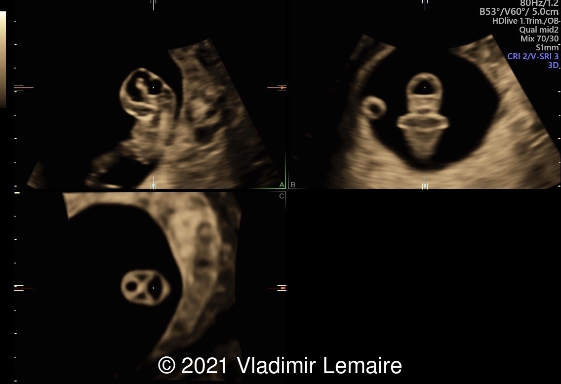 Three-dimensional ultrasound in multiplanar display of an embryo at 8weeks of gestation showing the brain vesicles.