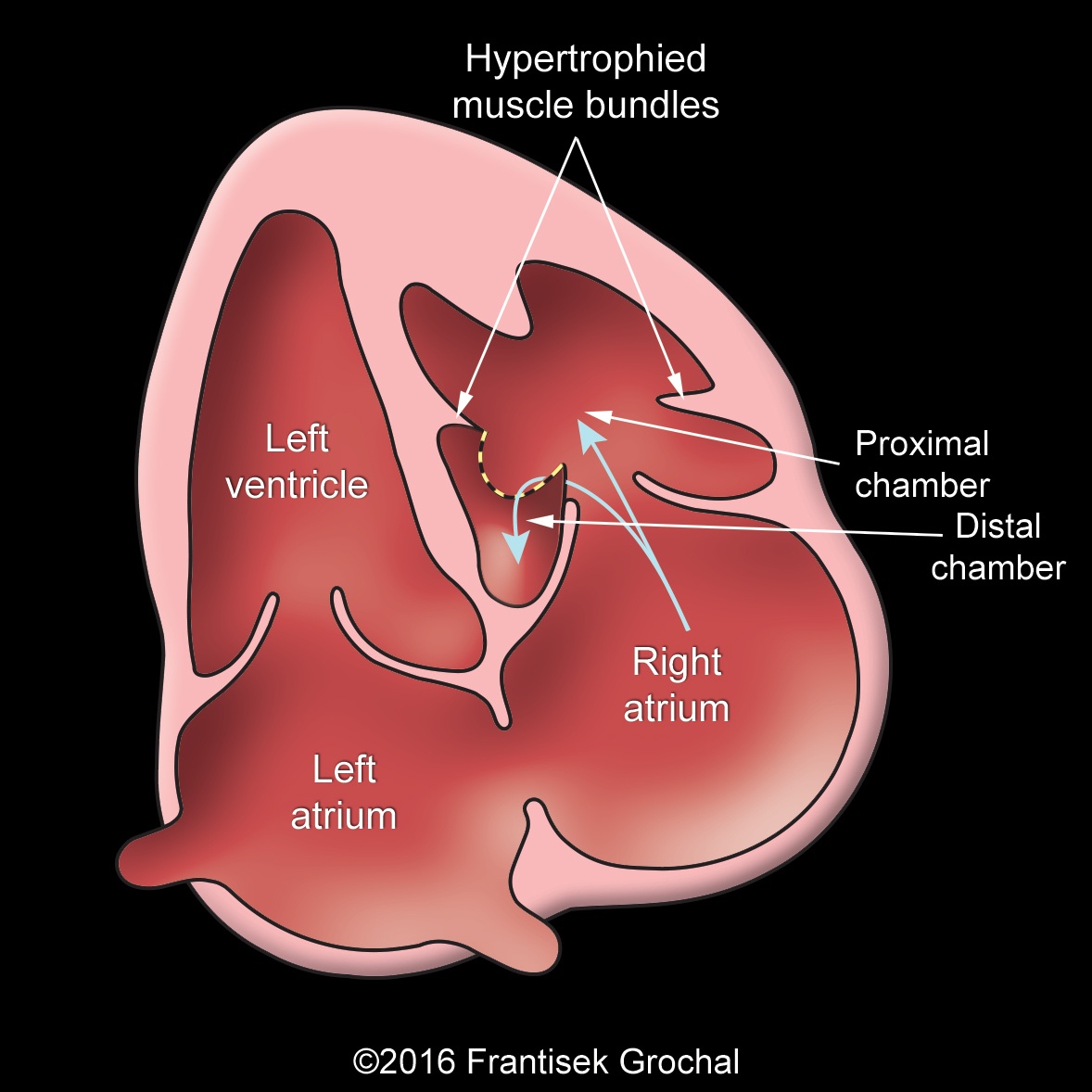 Double-chambered-right-ventricle-FG-drawing