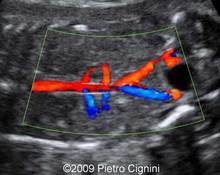 Double renal artery image
