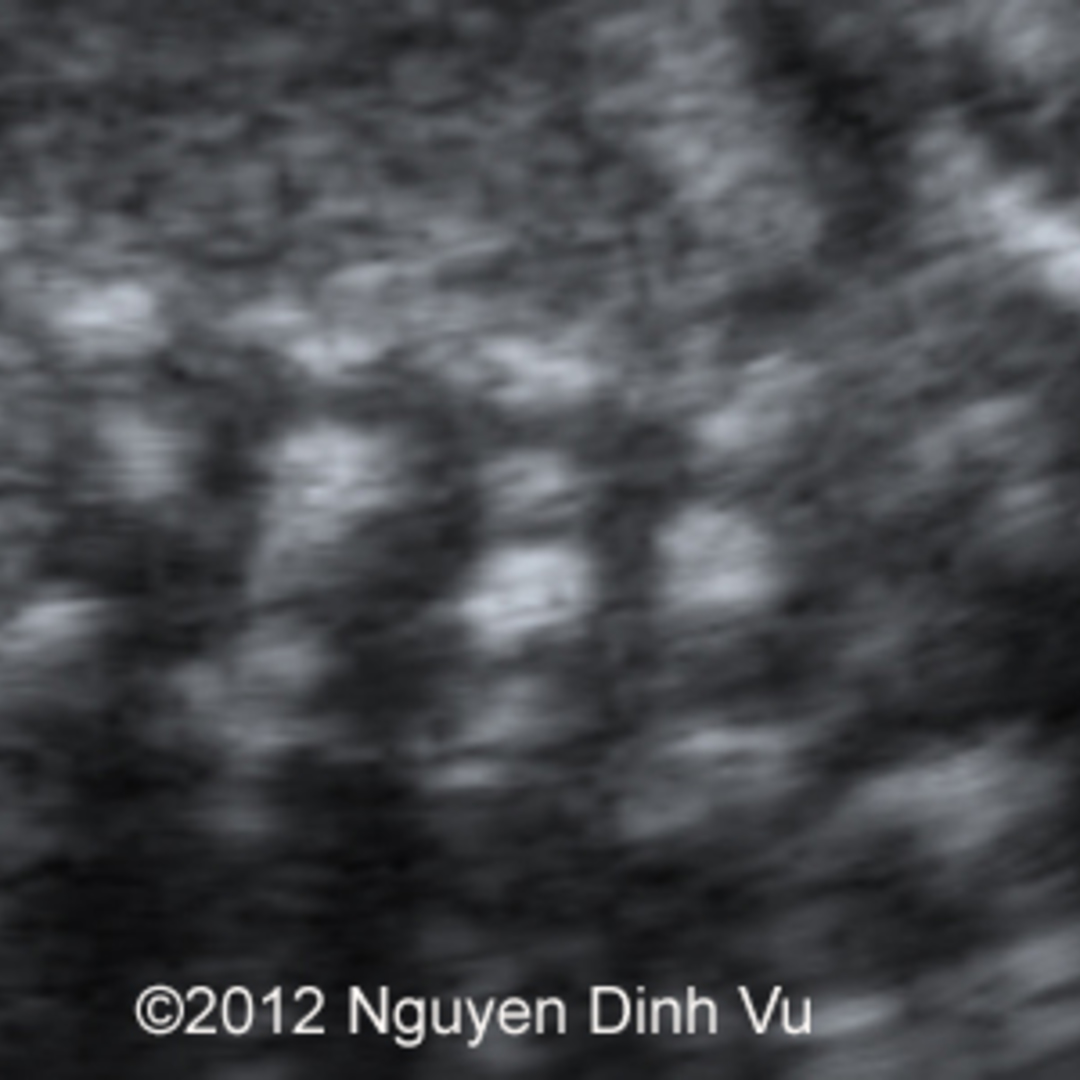 📃 Butterfly vertebra