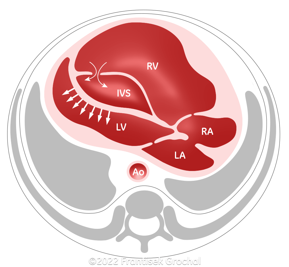  As blood accumulates in the interventricular septum, the left septal wall bulges into the left ventricular cavity. (RV–right ventricle; LV–left ventricle; IVS–interventricular septum; RA–right atrium; LA–left atrium; Ao–aorta)