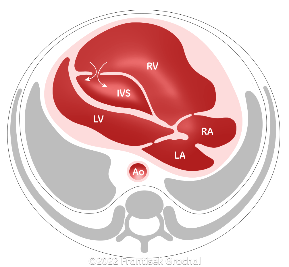 Drawing - four-chamber view of the heart with dissecting aneurysm of the interventricular septum. RV – right ventricle, LV – left ventricle, IVS – interventricular septum, RA – right atrium, LA – left atrium, Ao – aorta.