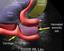 Cervical incompetence, herniated amniotic sac through the cervical cerclage image