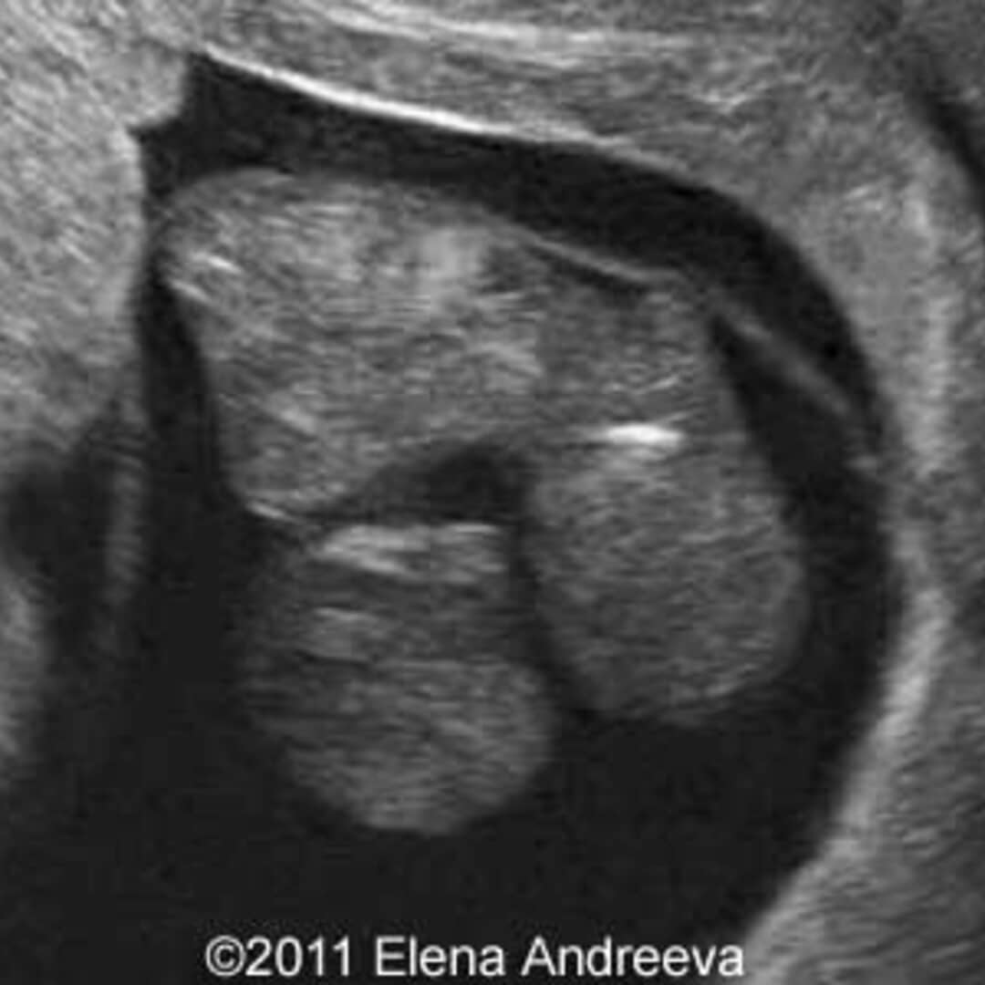 рџ ѓ Conjoined Twins