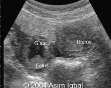 Ectopic pregnancy, tubal image