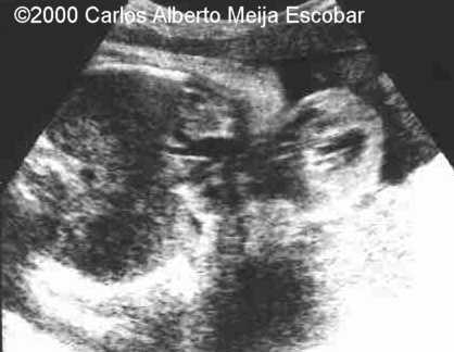 ectopia_cordis_ultrasound