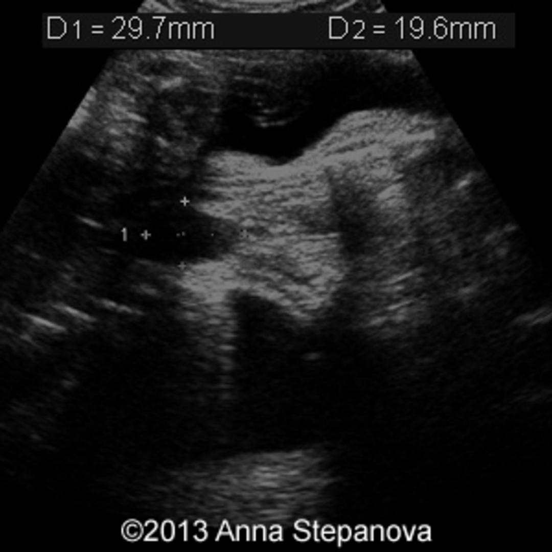 📃 Esophageal atresia with intracranial cyst and horseshoe kidney