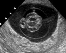 Acardiac triplet image