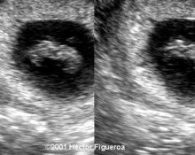 Twins, conjoined, 8 weeks image