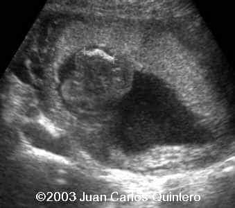 femur 18 weeks
