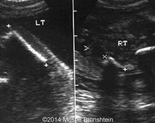 Proximal femoral deficiency, 16 weeks image