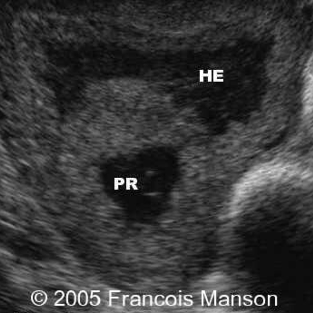 1 Cornual Ectopic Pregnancy Reproduced With Permissio