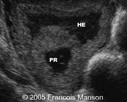 📃 Ectopic pregnancy, cornual
